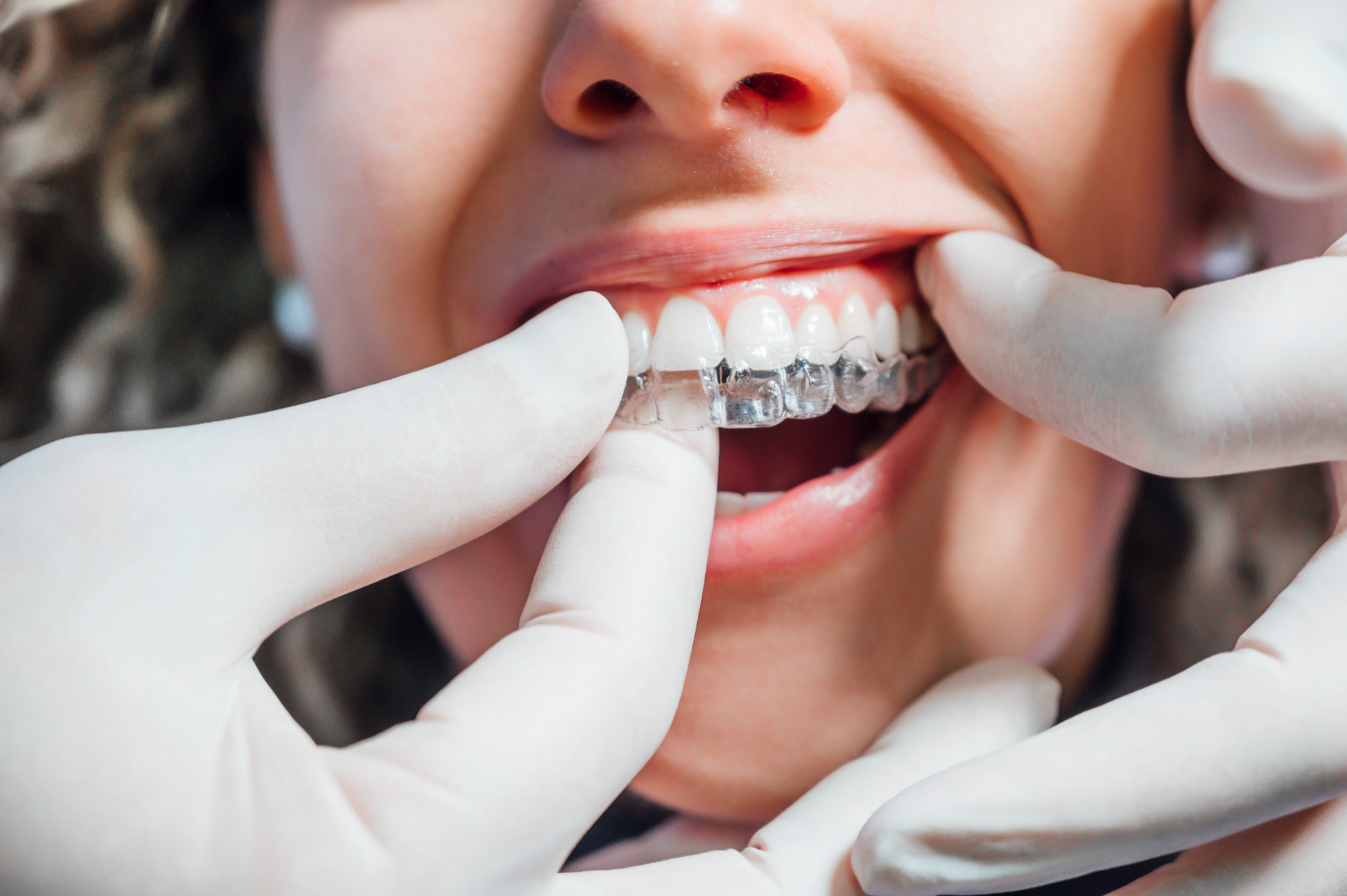Aligner-Behandlung bei verschiedenen Zahnfehlstellungen